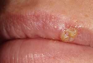 Herpes labialis (вирус простого герпеса)