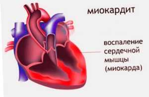 Миокардит и перикардит