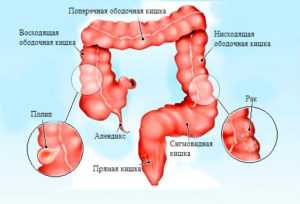 Поражение сигмовидной кишки