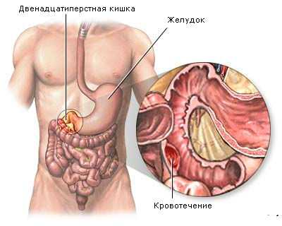 Кровотечение из желудка – характеристика заболевания ЖКТ