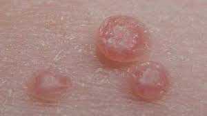 Molluscum contagiosum