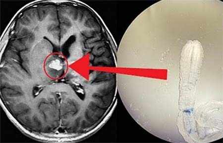 Личинки свиного солитера в мозгу