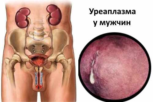 Уреаплазма уреалитикум у мужчин