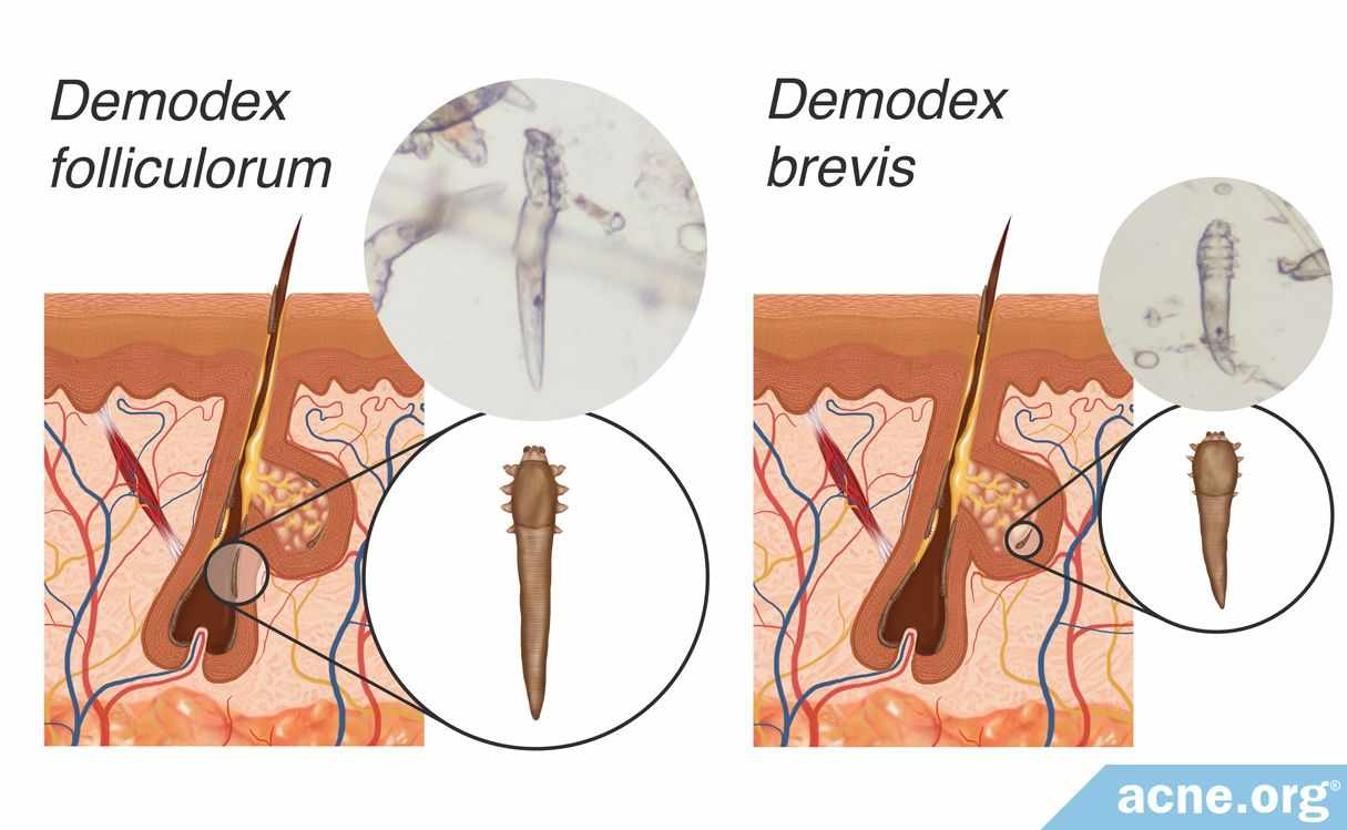 Demodex Folliculorum