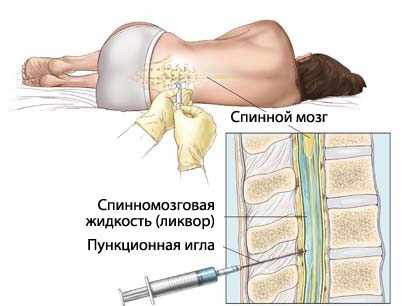 Получение спинномозговой жидкости