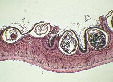 Gongylonema