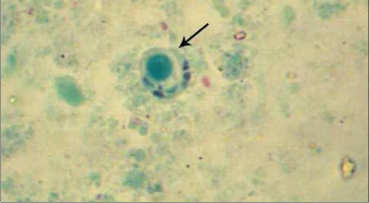 Blastocystis Spp