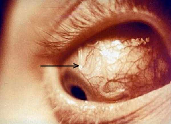Паразит в глазу