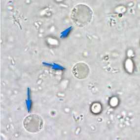 Blastocystis Spp у ребенка