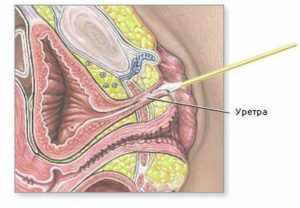 Выделения из мочеиспускательного канала (уретры) у женщин и мужчин