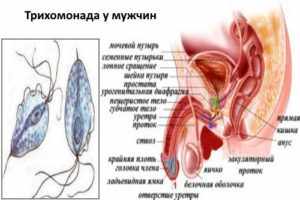 Трихомониаз у мужчин