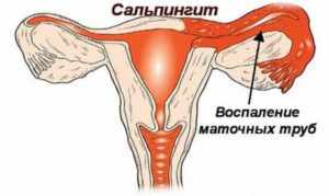 сальпингита