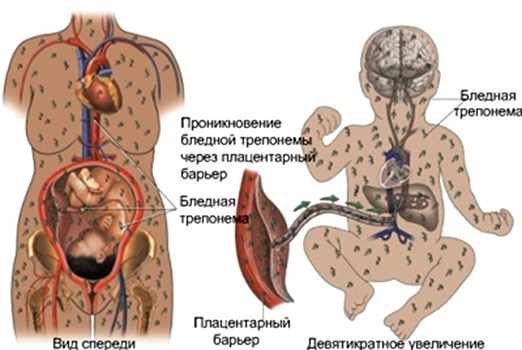 Врожденный сифилис у детей