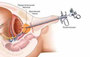 Трансуретральная эретрорезекция