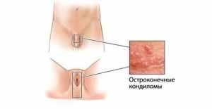 папилломы на интимных местах