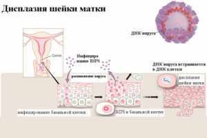 Папиллома шейки матки