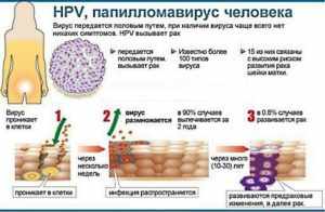 Вирус папилломы человека у женщин в гинекологии