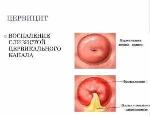 Воспаление у женщин