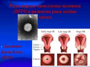 папиллома шейки матки
