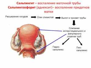 сальпингита