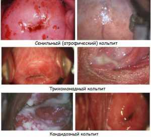 Специфический кольпит