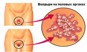 Причины появления волдырей на половых губах у женщин. На какие симптомы следует обратить внимание и обратиться за диагностикой, чтобы своевременно начать выбрать метод лечения белых пузырьков на половых органах.