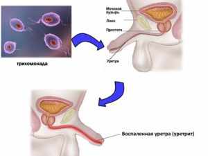 Трихомонадный уретрит у мужчин