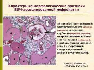 ВИЧ-ассоциированная нефропатия