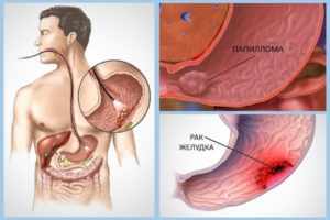 папилломы в желудке