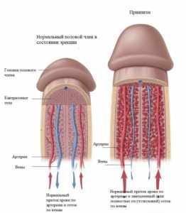 приапизм