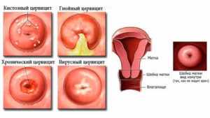 разновидность цервицита