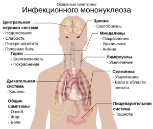 Инфекционный мононуклеоз