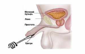 папиллома уретры