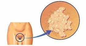 Папилломы во влагалище