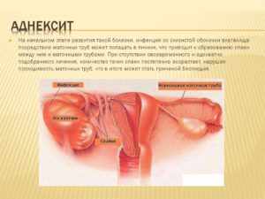 Лечение хронического сальпингоофорита