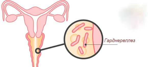 Гарднереллез