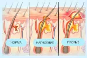 фурункул на лобковой части у женщин