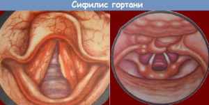 Сифилис горла