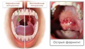 Хламидийный фарингит симптом