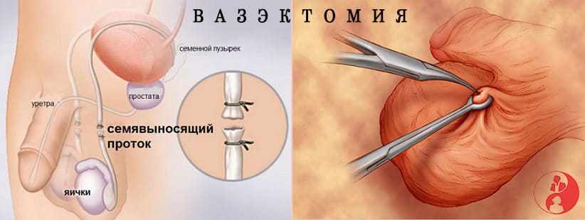 Вазэктомия для мужчин