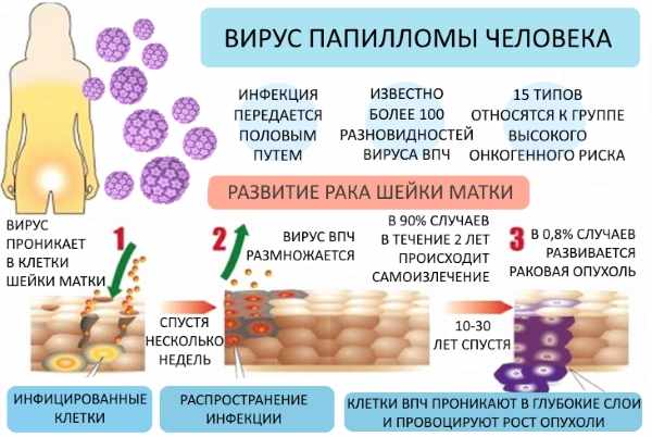 razvitie-opuholi-pri-vpch