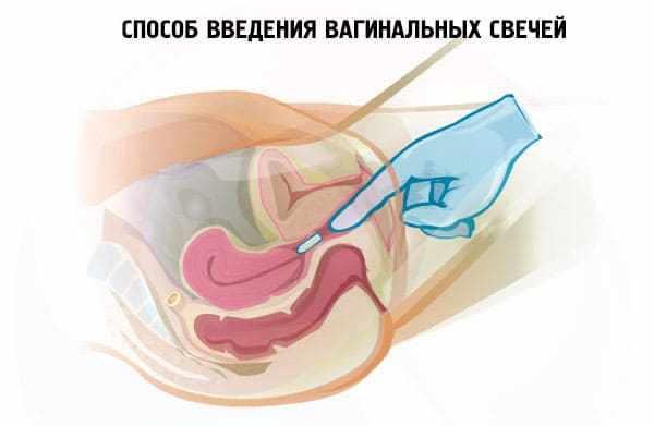 как вводить свечи женщинам