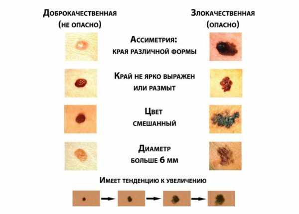 Меланома кожи