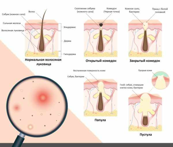 Виды акне