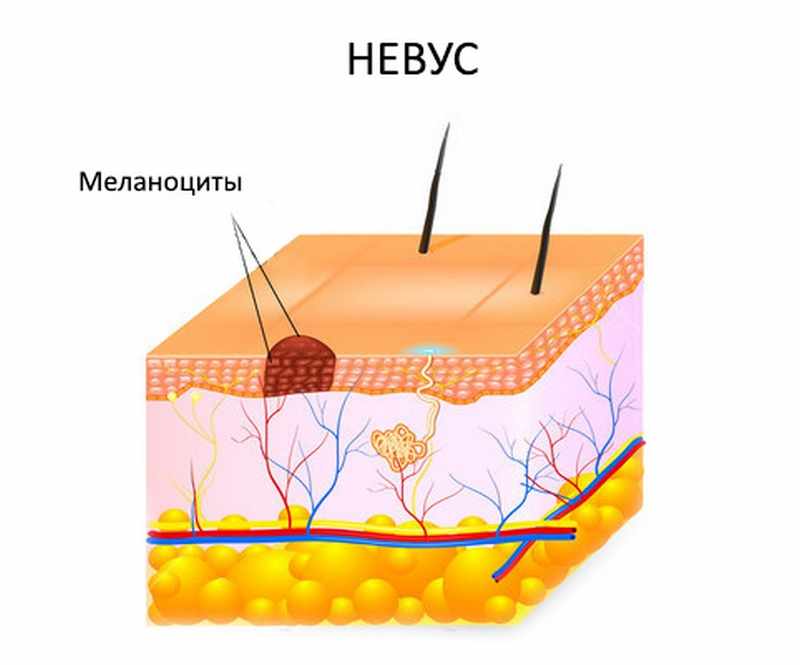 Скопление меланина