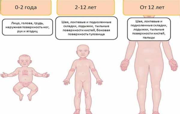 Область локализации потницы