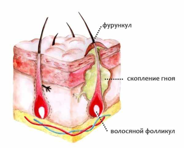 Схема фурункула