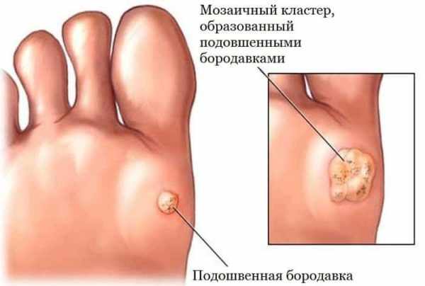 Методы удаления подошвенных бородавок у детей