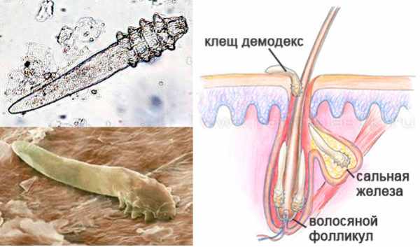 Клещ демодекс