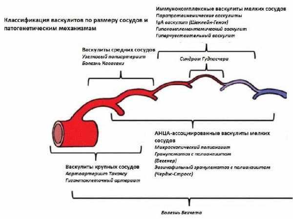 Классификация васкулитов